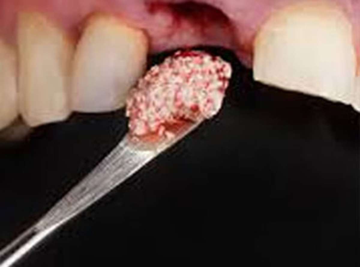 Guided Tissue/Bone Regeneration near me
